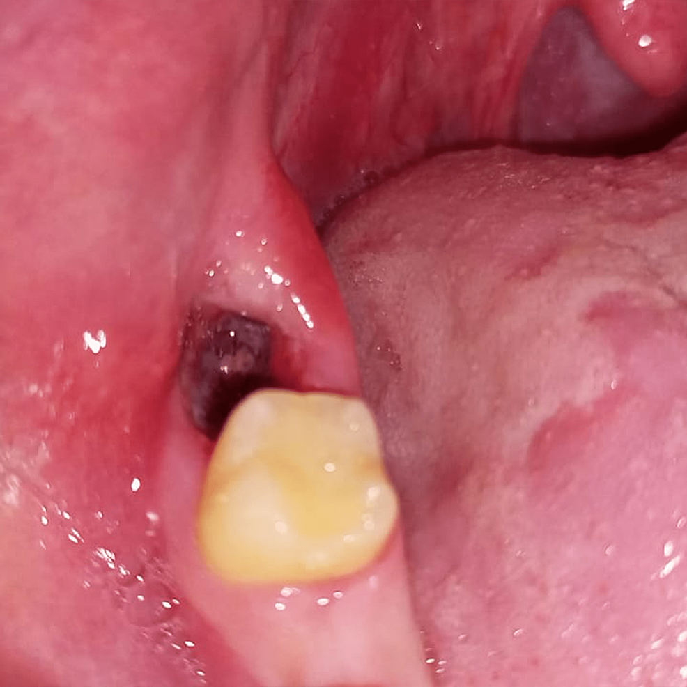 Is this a dry socket or infection? : r/DentalSchool