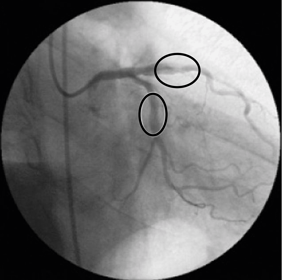 Cureus | Intraoperative Coronary Spasm: A Potential Case of Vasospastic ...