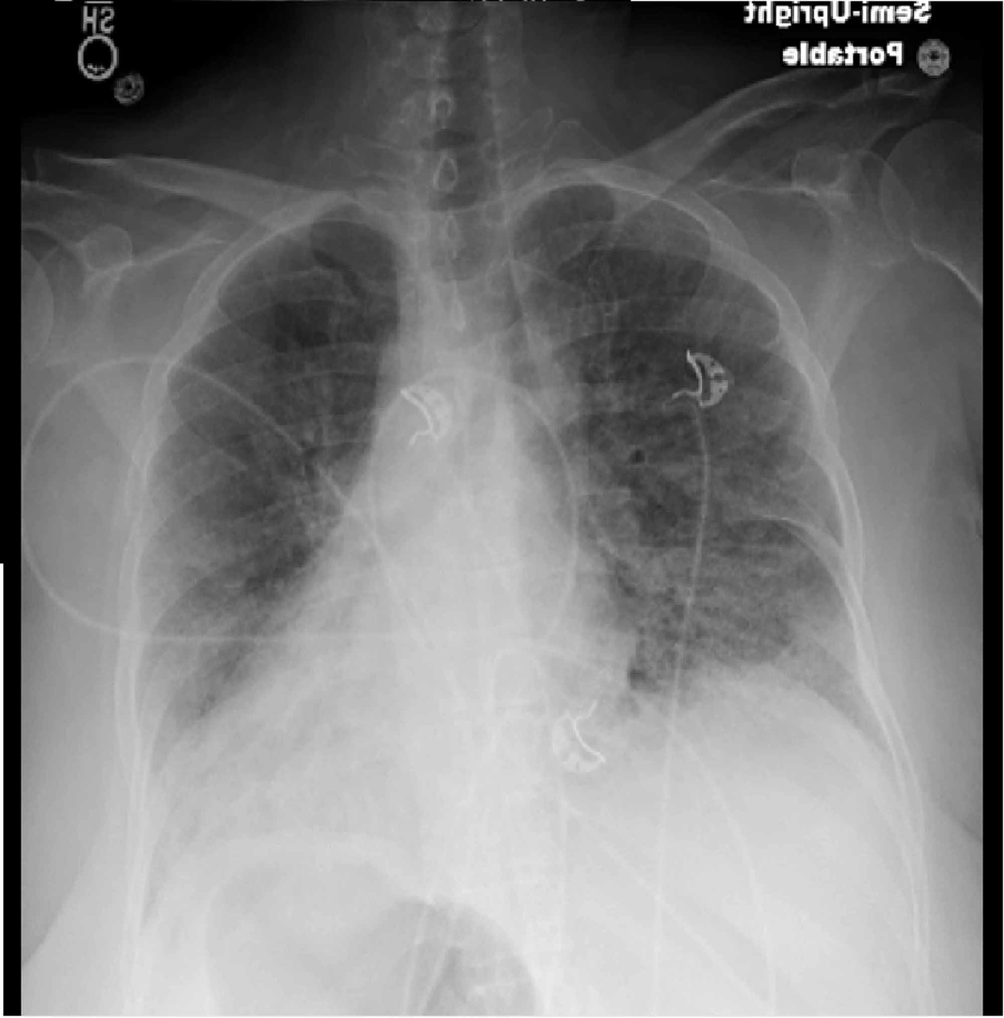 Cureus | Diffused Alveolar Hemorrhage in the Setting of Scleroderma ...