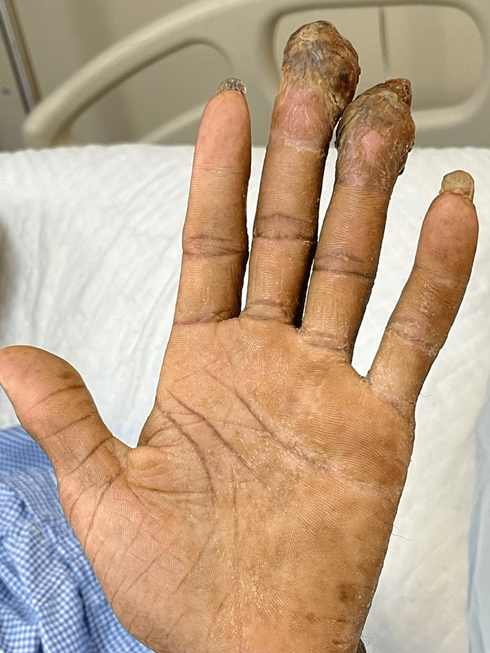 3 unusual symptoms of Omicron infection that show on your skin
