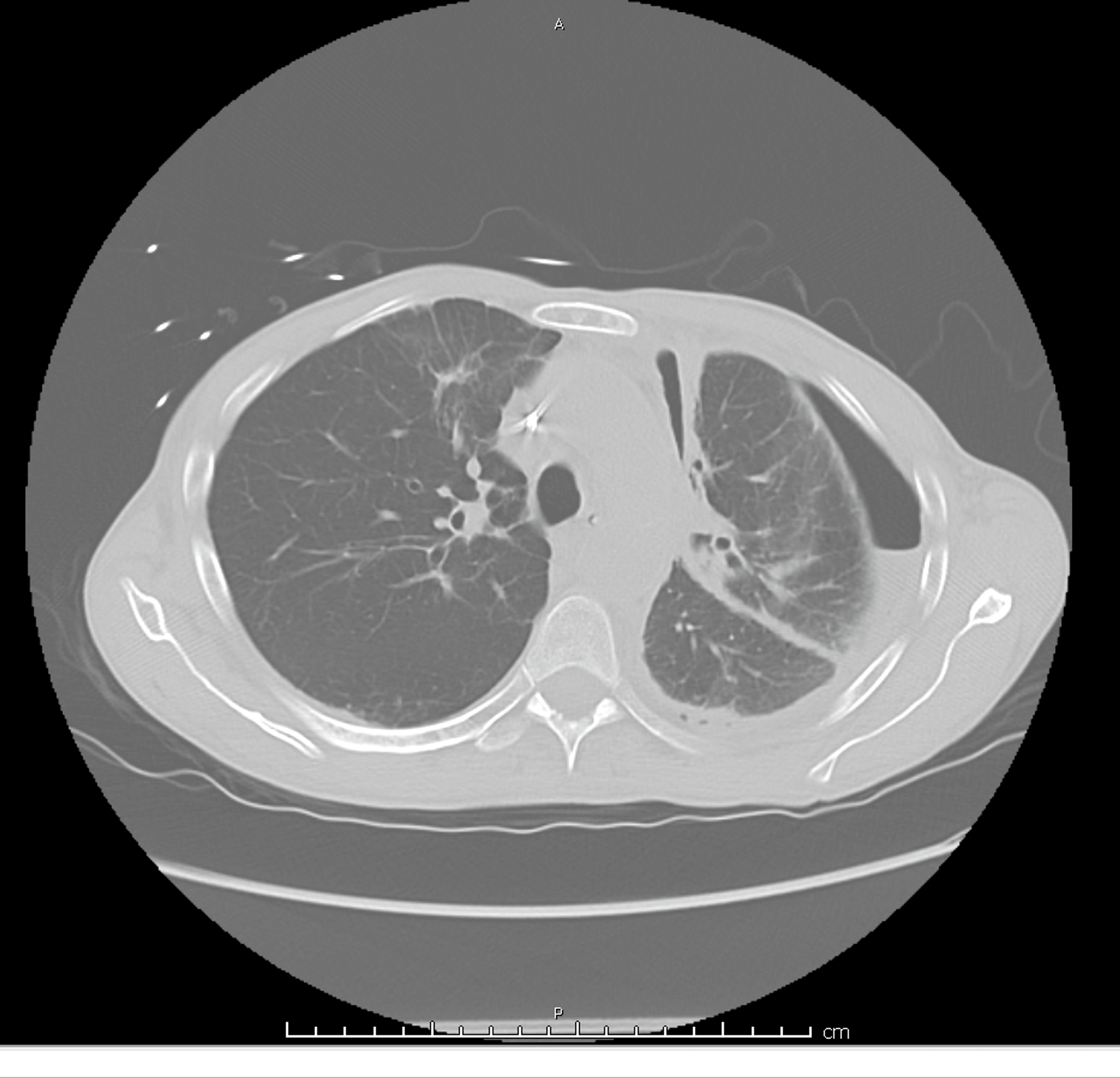 Cureus | Pneumothorax Ex Vacuo: A Rare Complication of PleurX Catheter ...