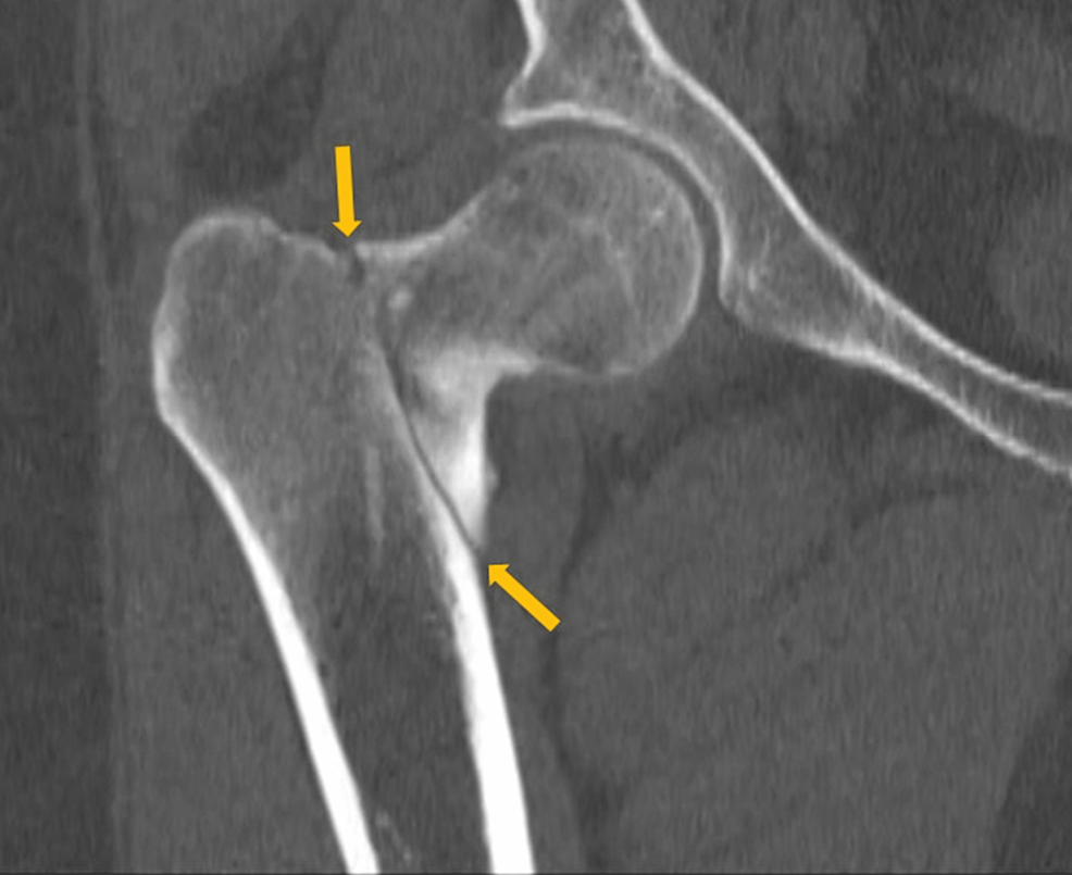 A-CT-scan-showing-the-right-intertrochanteric-fracture-of-the-right-femur-(yellow-arrows)