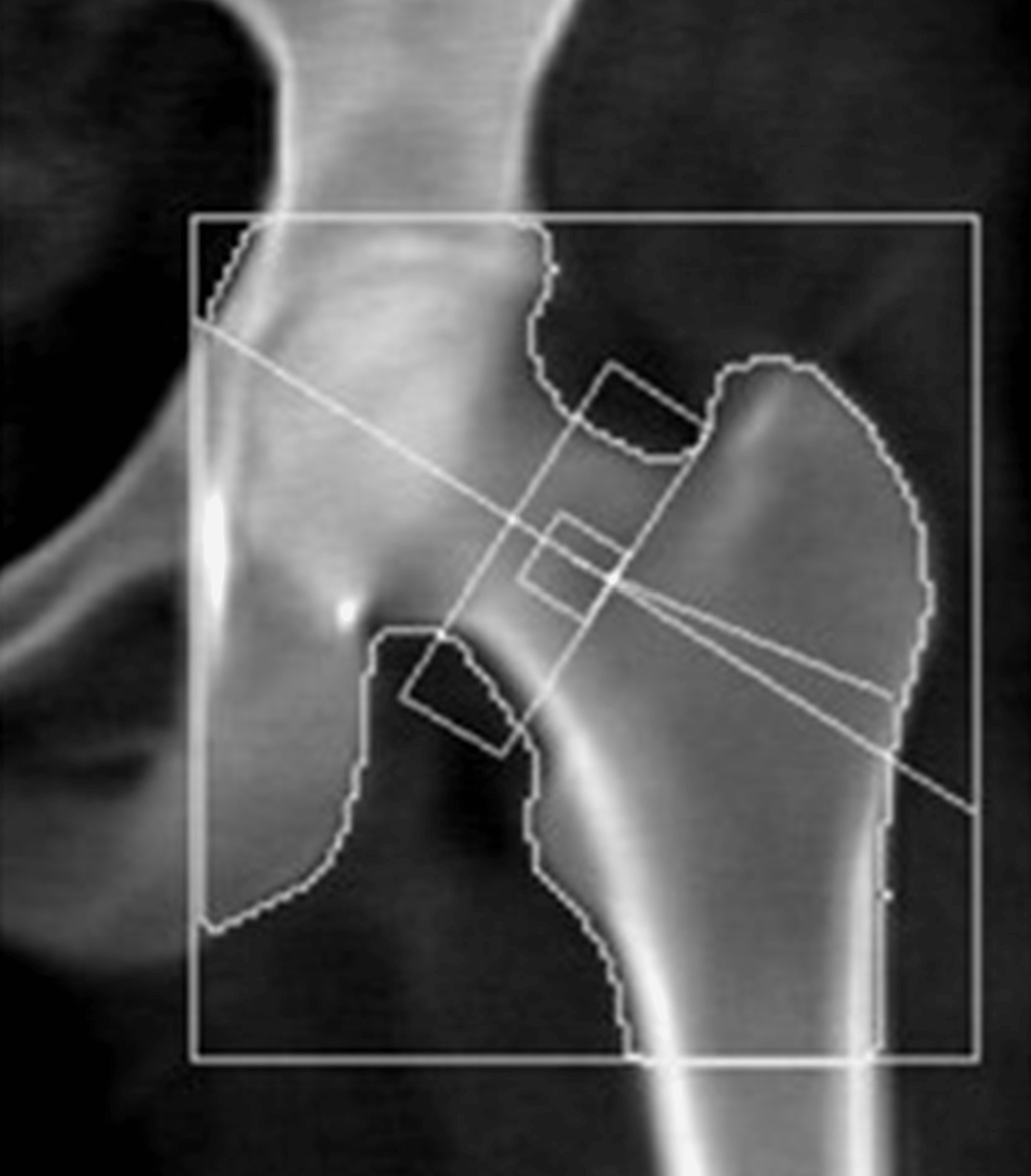 Dual-energy-X-ray-absorptiometry-(DEXA)-scan-of-the-femoral-neck-showing-osteopenia