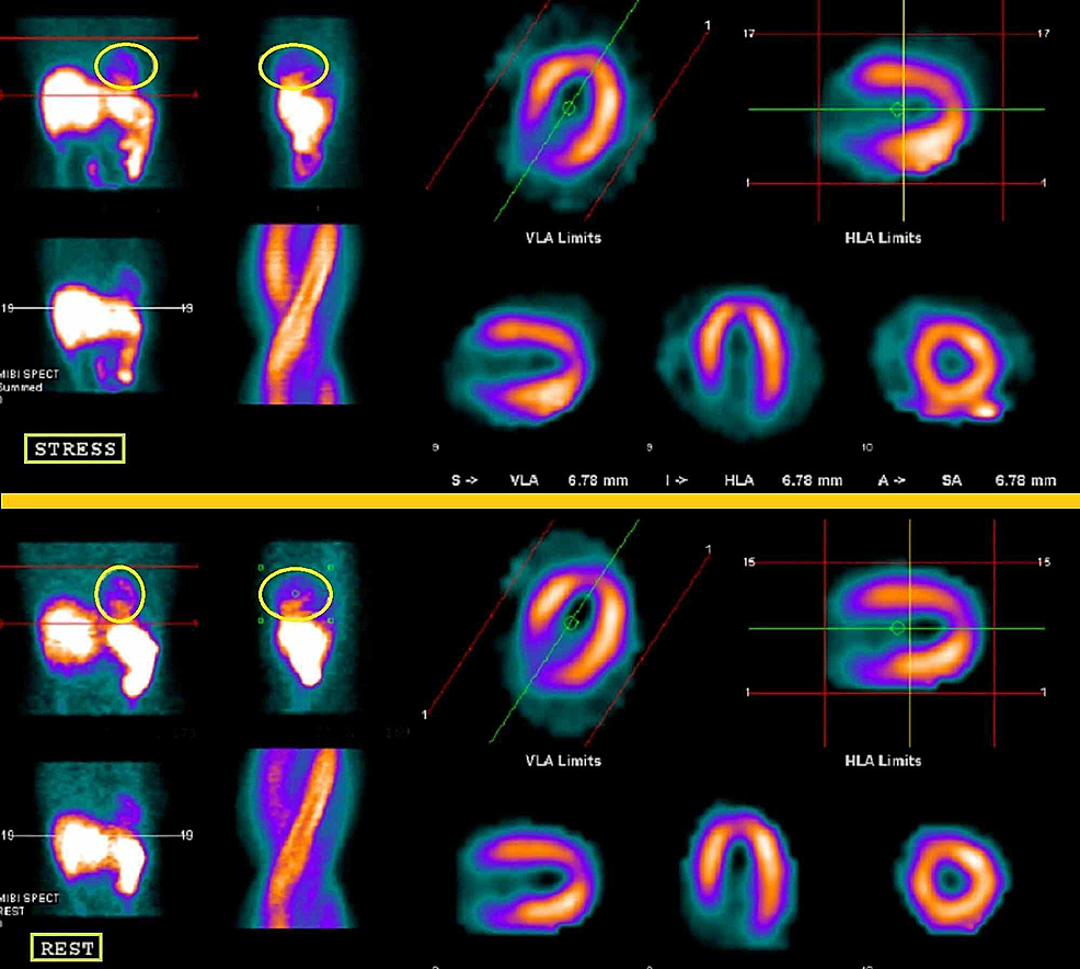 Cureus | Spontaneous Coronary Artery Dissection Associated with Anal ...