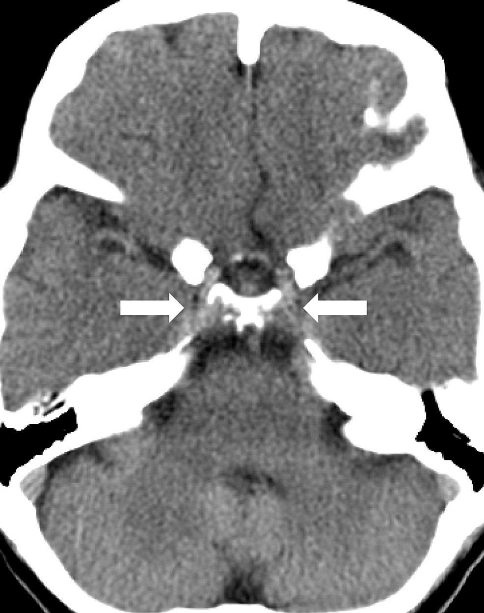 cureus-primary-central-nervous-system-lymphoma-presenting-as-isolated