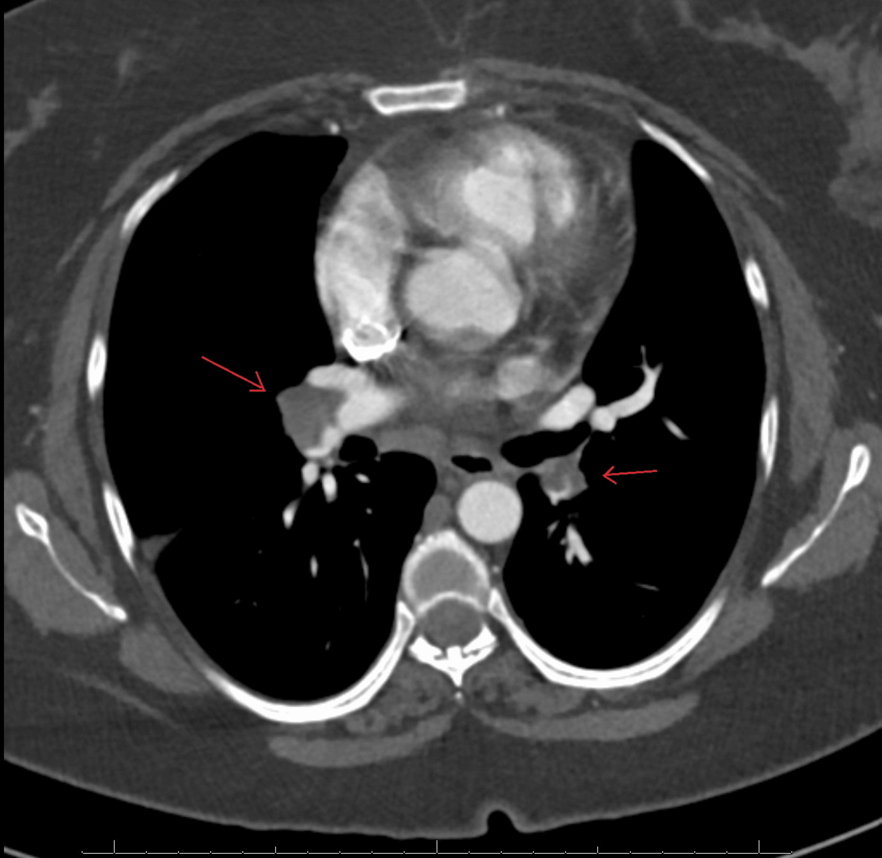 Cureus Protein S Deficiency and COVID19 A Brutal Combination