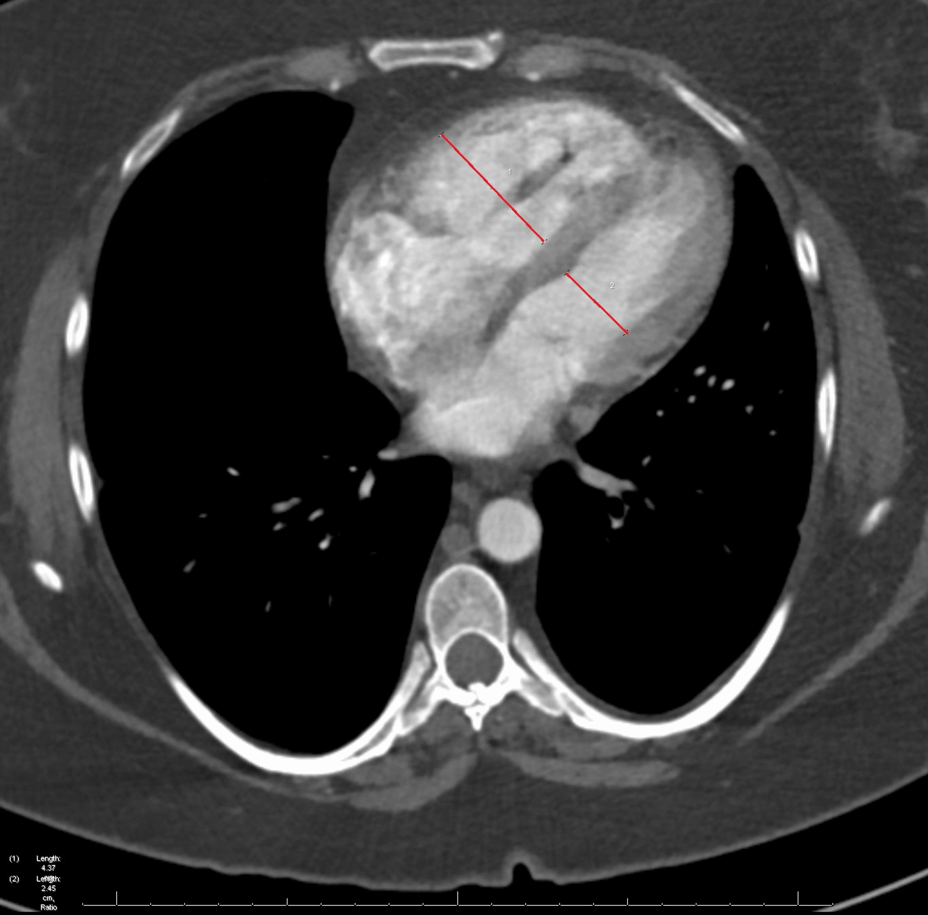 Cureus Protein S Deficiency and COVID19 A Brutal Combination