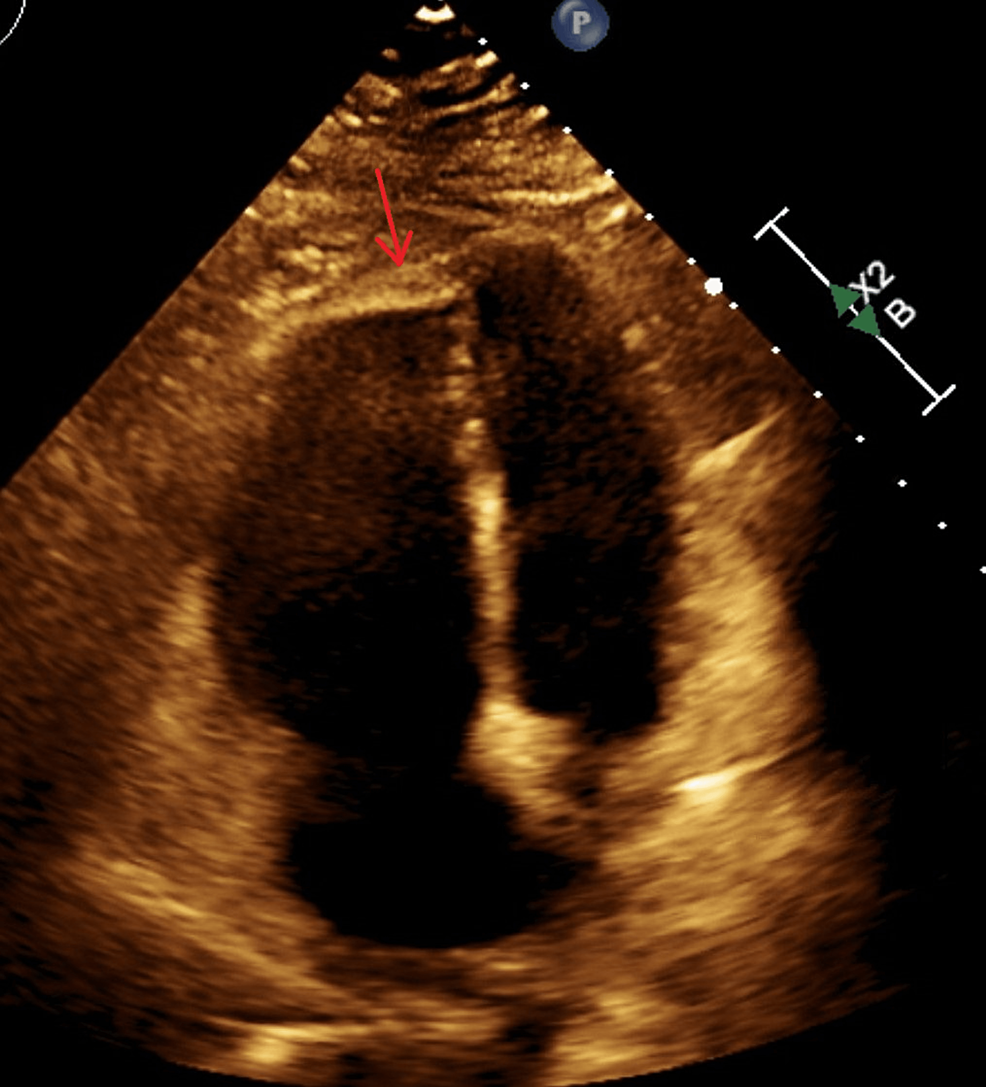 Cureus Protein S Deficiency and COVID19 A Brutal Combination
