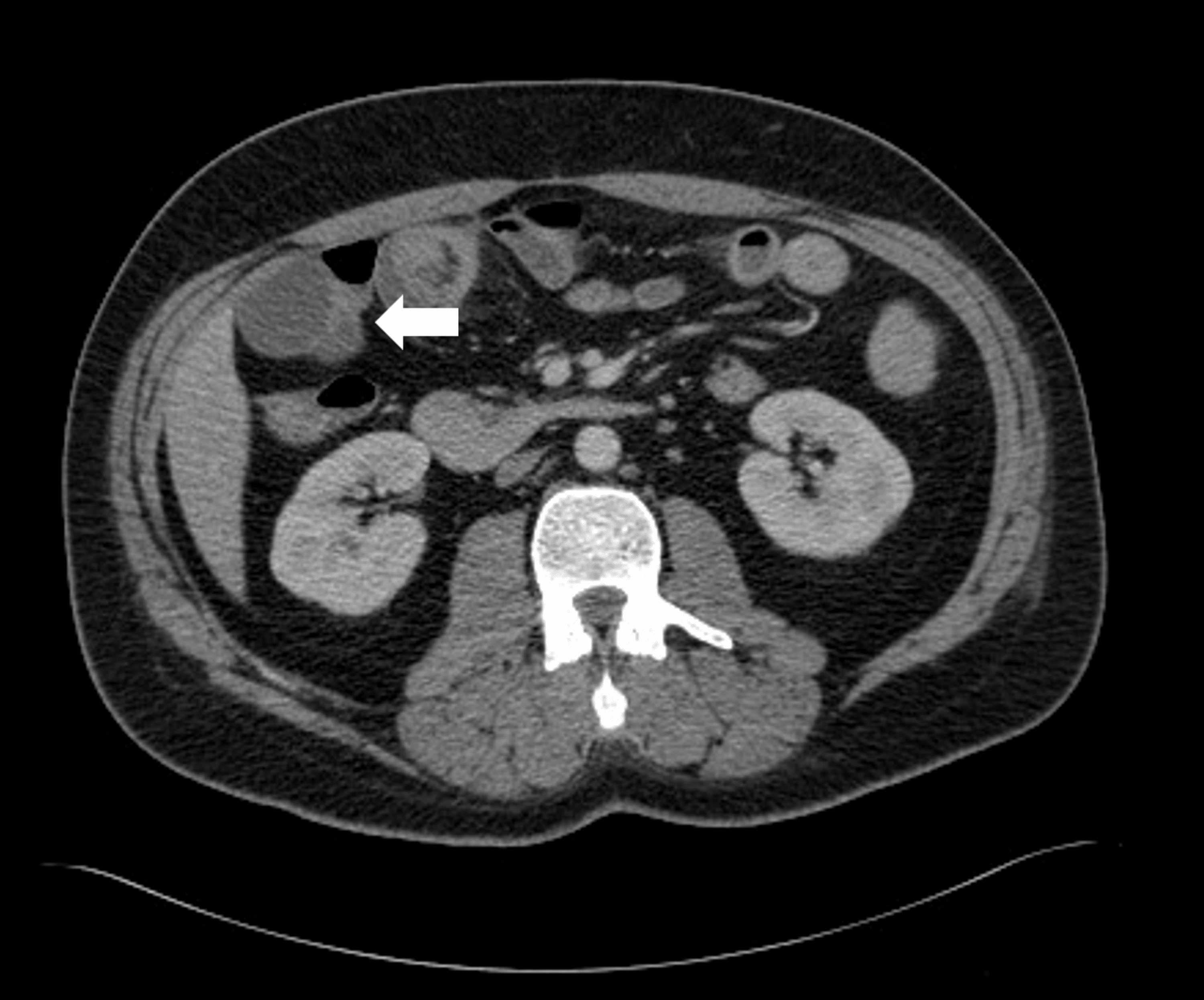 Solitary Fibrous Tumor Of The Shoulder Metastasizing To The Small solitary-fibrous-tumor-of-the-shoulder-metastasizing-to-the-small