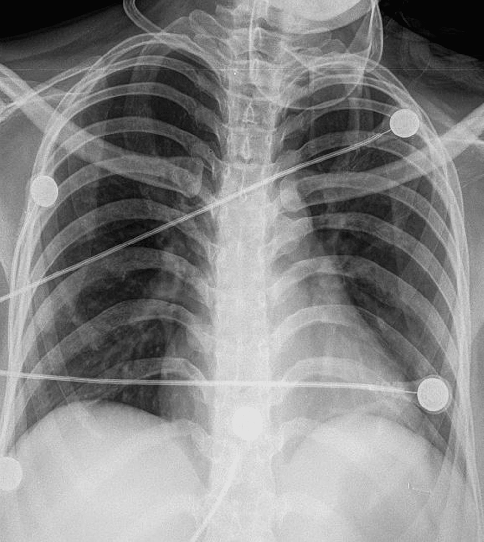 Cureus | A Rare Phenomenon of Stercoral Ileal Perforation in a Pregnant