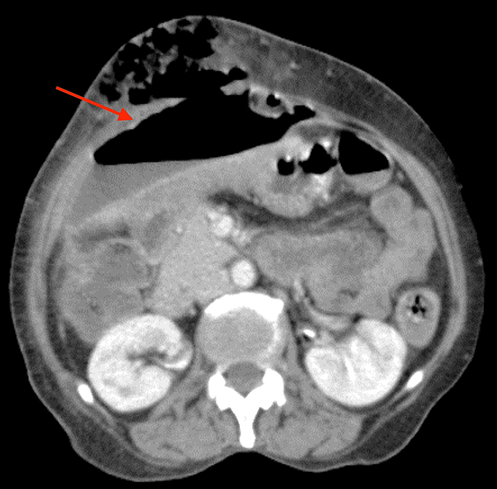 Cureus An Anterior Abdominal Abscess As The Initial Presentation Of A Perforated Duodenal