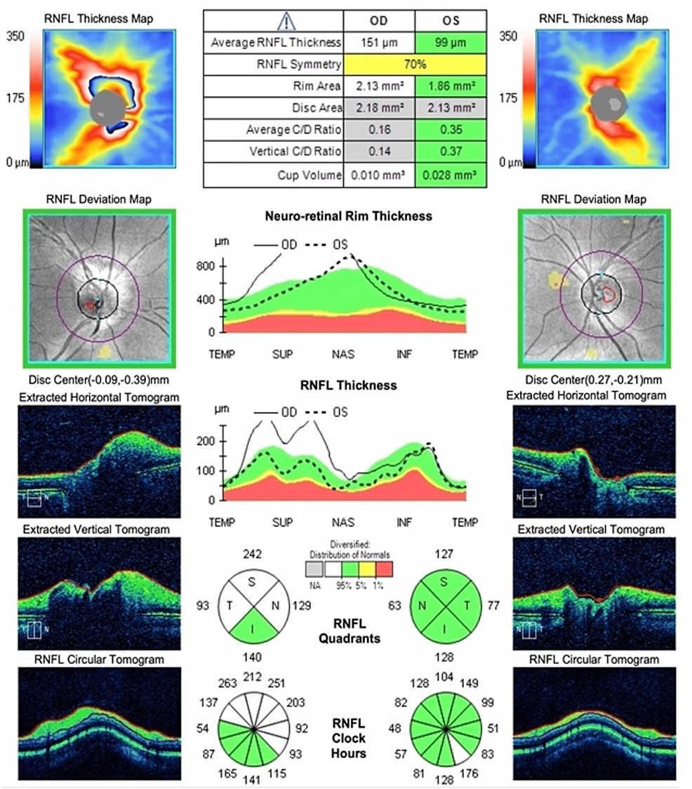 Diagnosis and Progression: RNFL and Optic Nerve Head Imaging - American  Academy of Ophthalmology