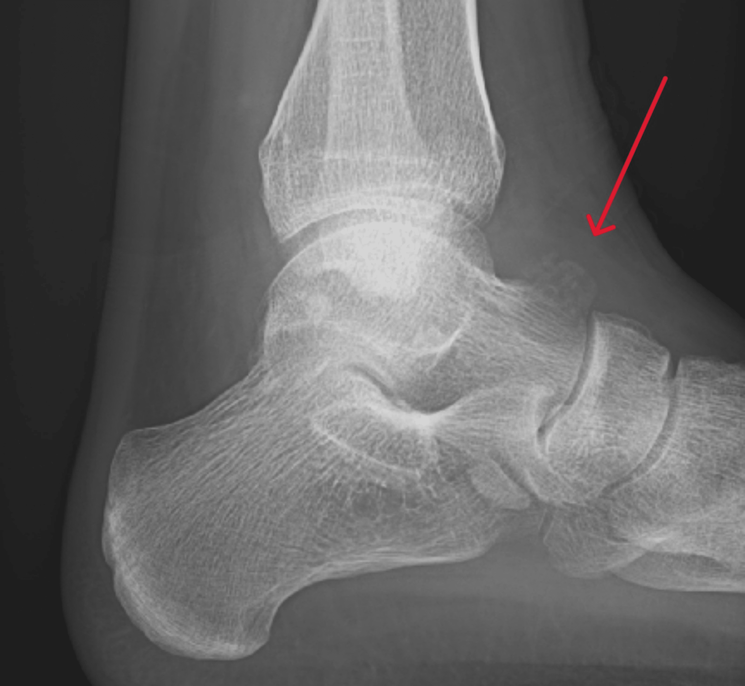 Cureus An Unusual Presentation of Giant Cell Tumour of Bone in the