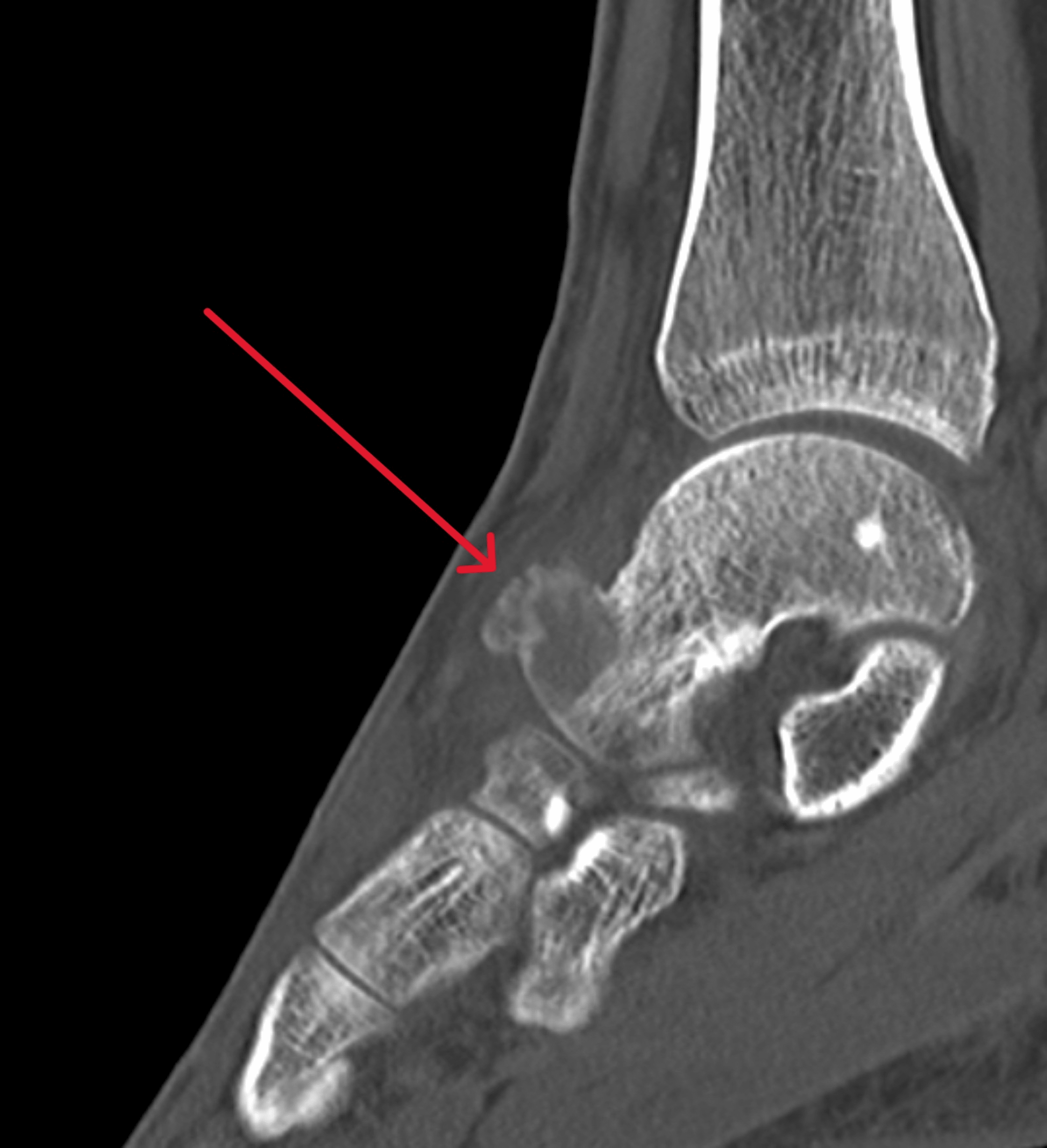 Cureus An Unusual Presentation of Giant Cell Tumour of Bone in the