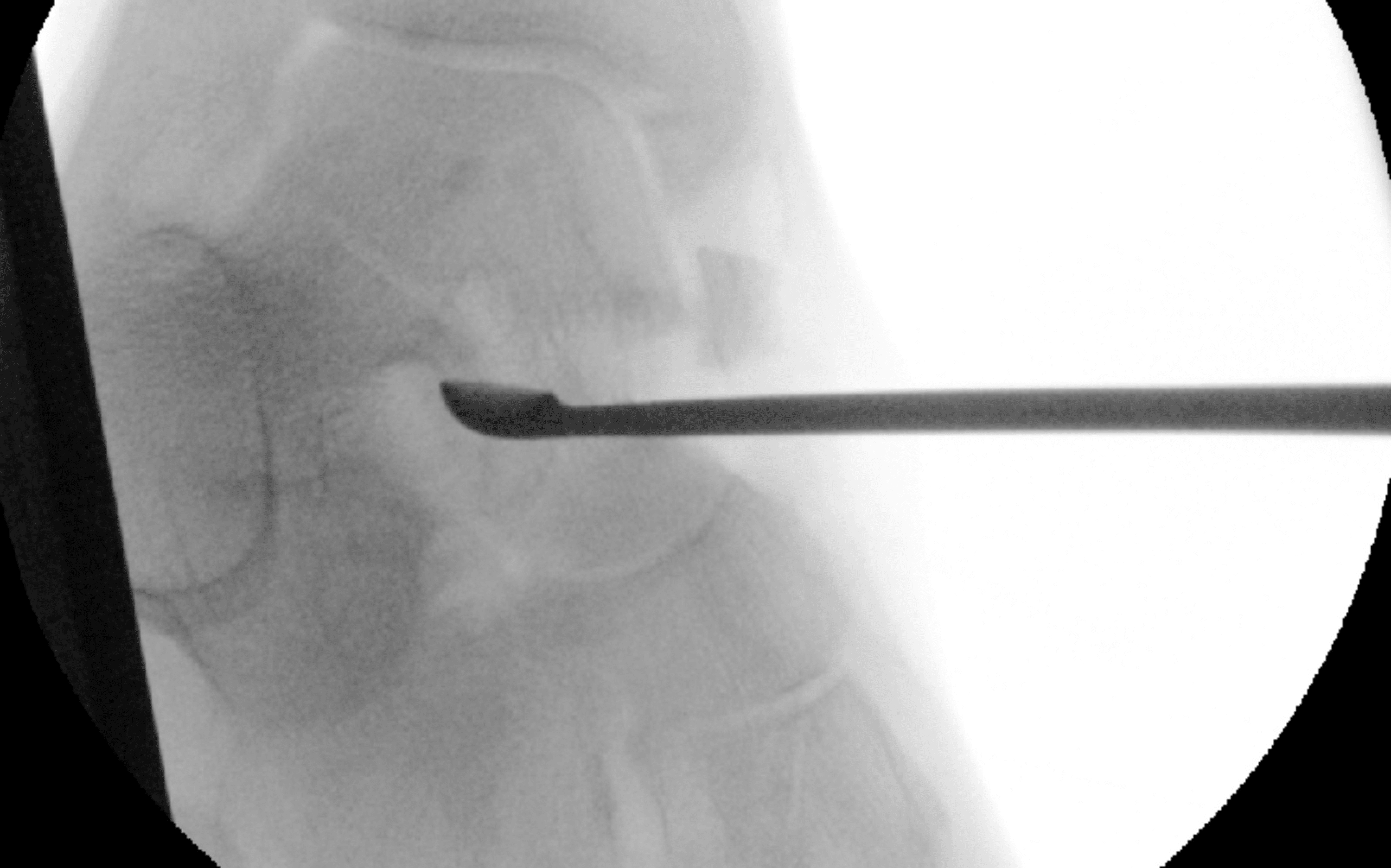Cureus An Unusual Presentation of Giant Cell Tumour of Bone in the