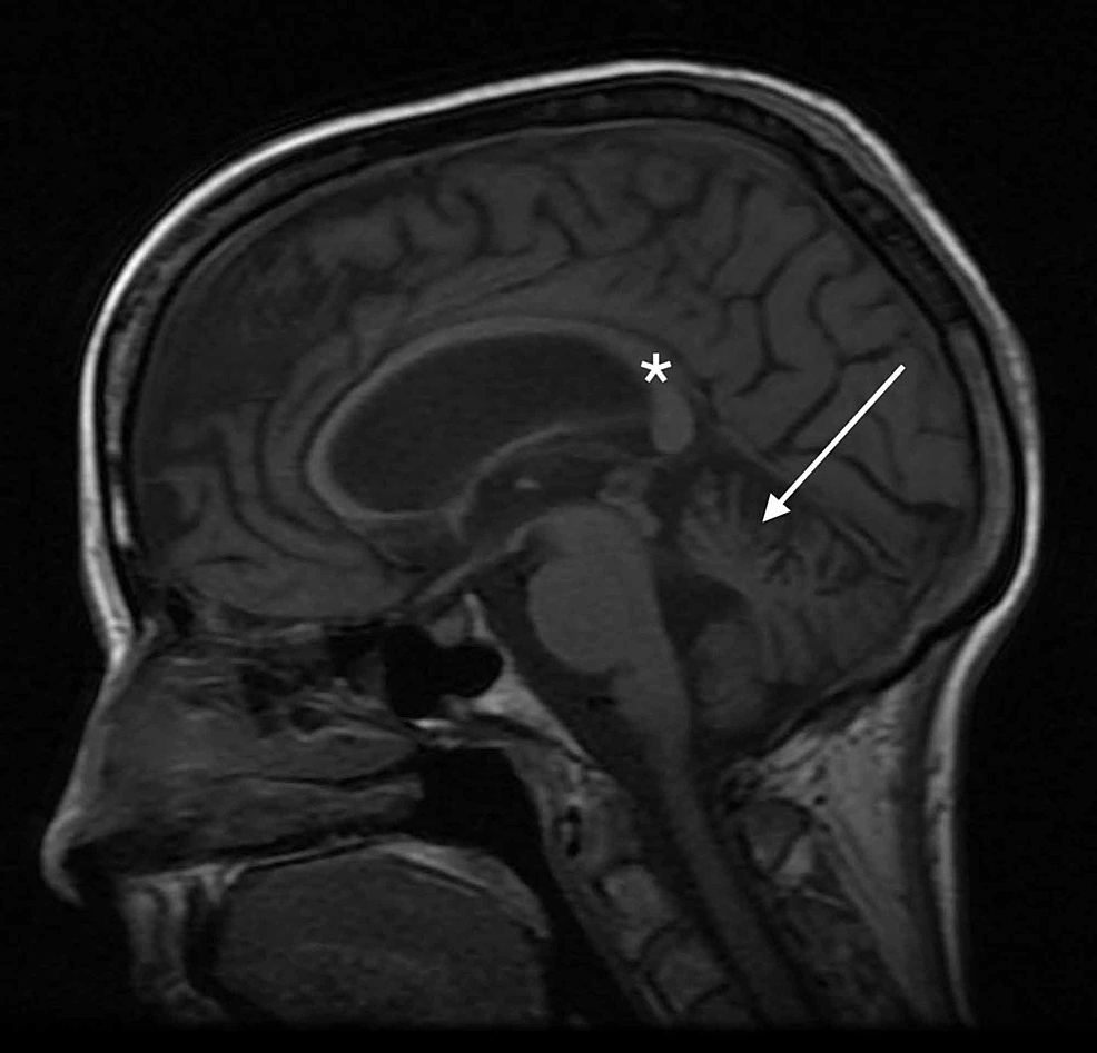 Cureus | Alcohol Induced Wernicke Encephalopathy with Atypical MRI Findings