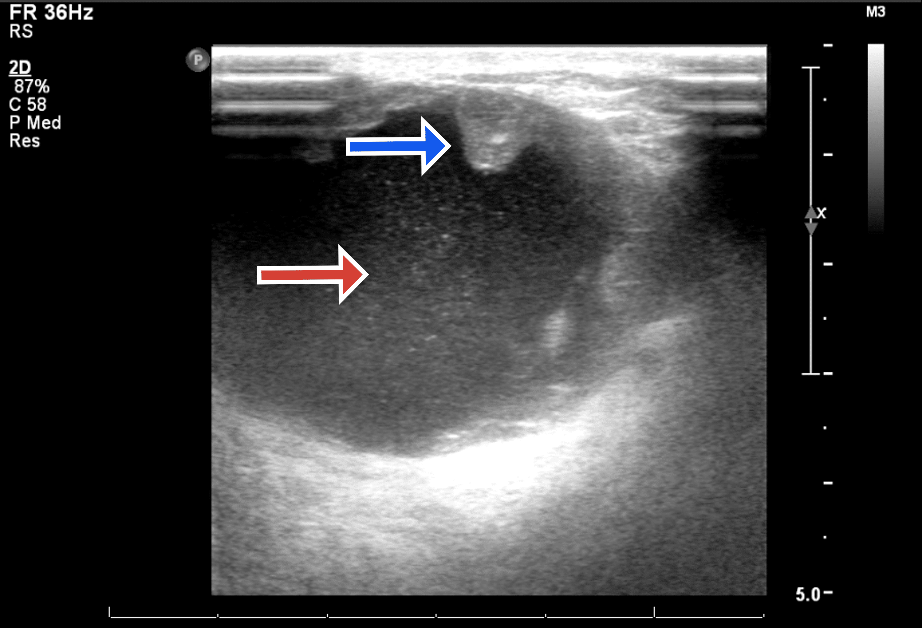 Cureus | Lymphoepithelial Carcinoma of the Breast