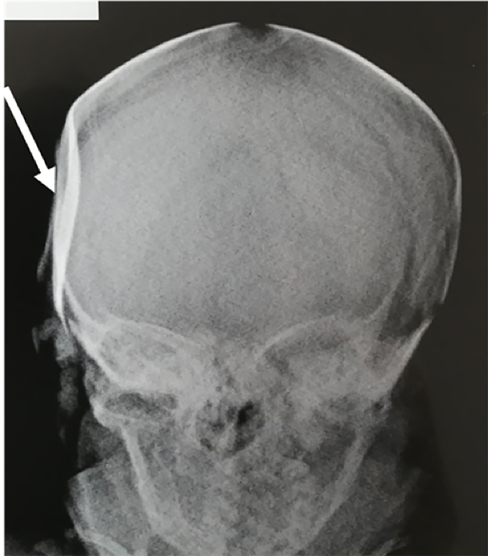 Recovery time fracture skull Management of