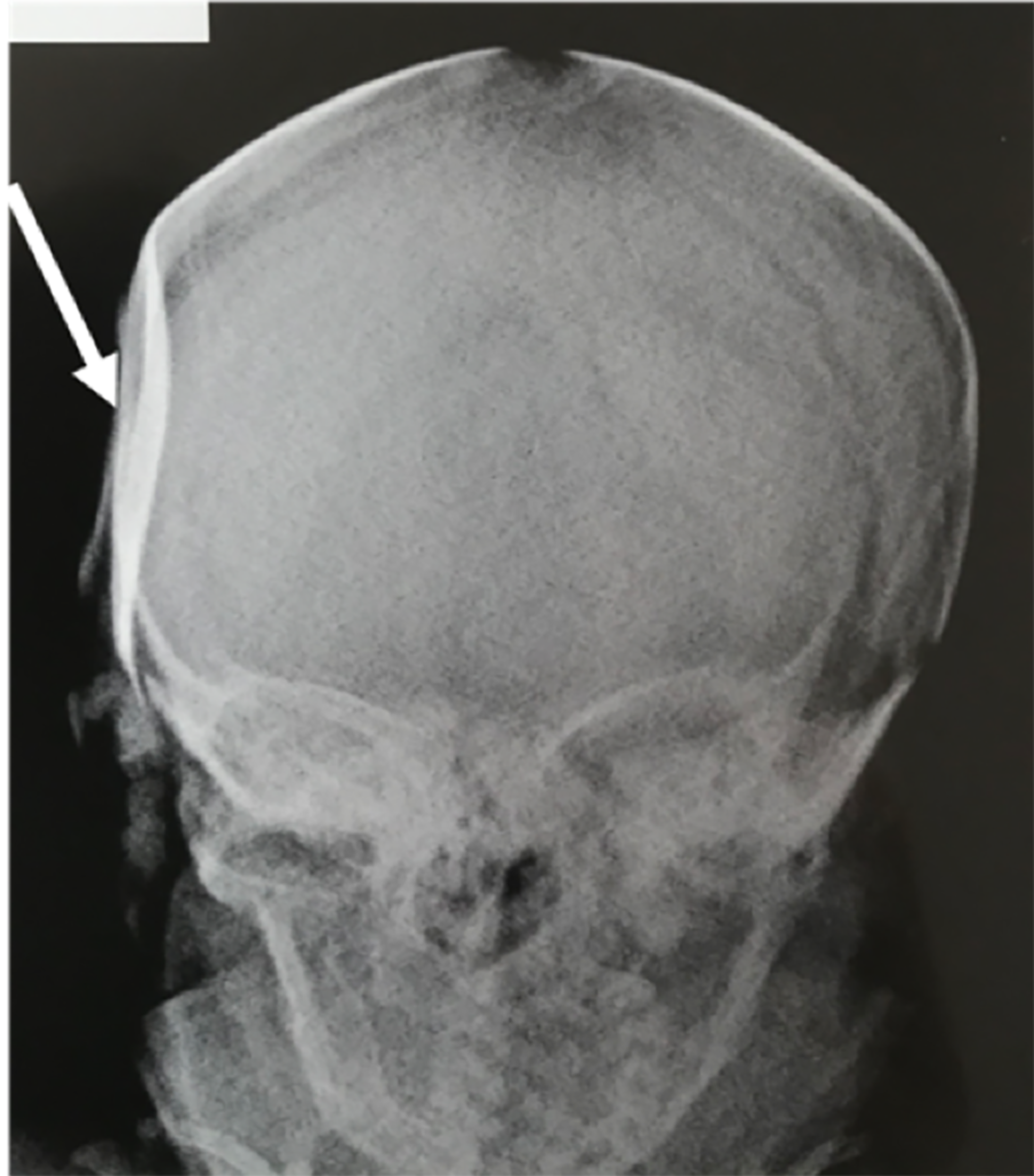 X Ray Of Skull Fracture Images