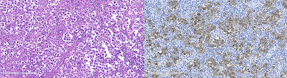 Cureus Exceedingly Rare Bilateral Synchronous Germ Cell Testicular Tumors With Different 6436