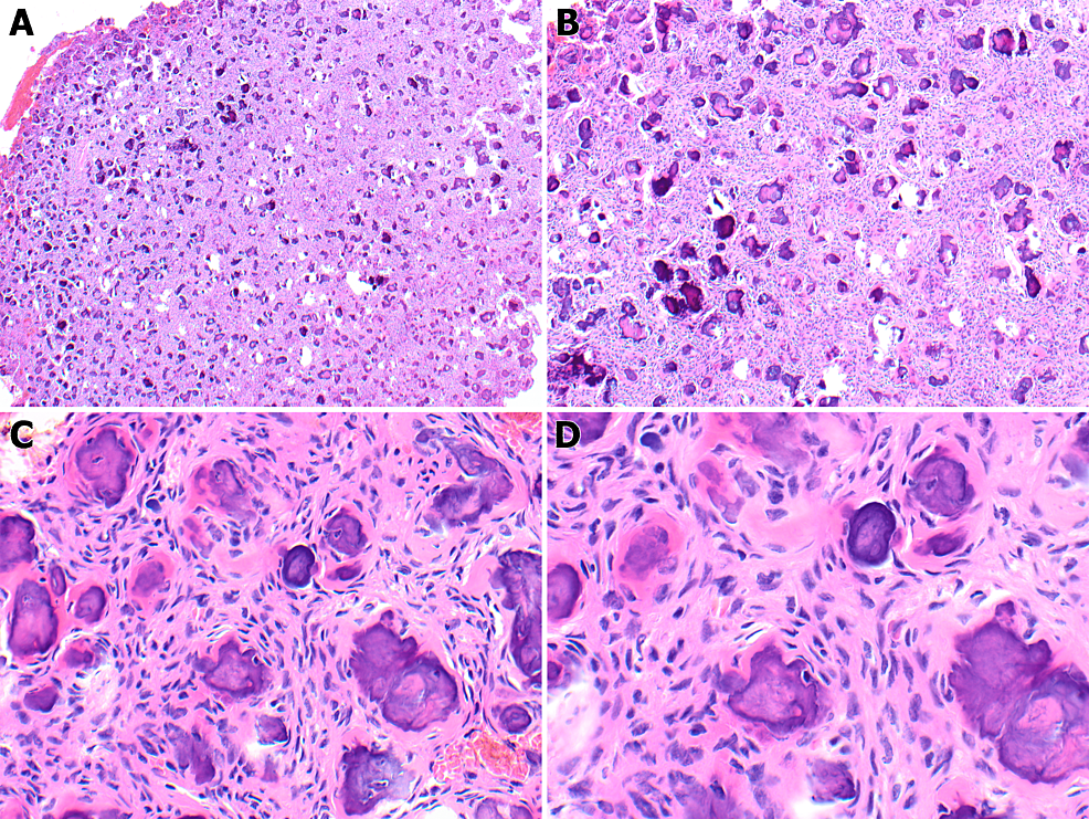 Cureus Cranial Juvenile Psammomatoid Ossifying Fibroma A Rare Entity