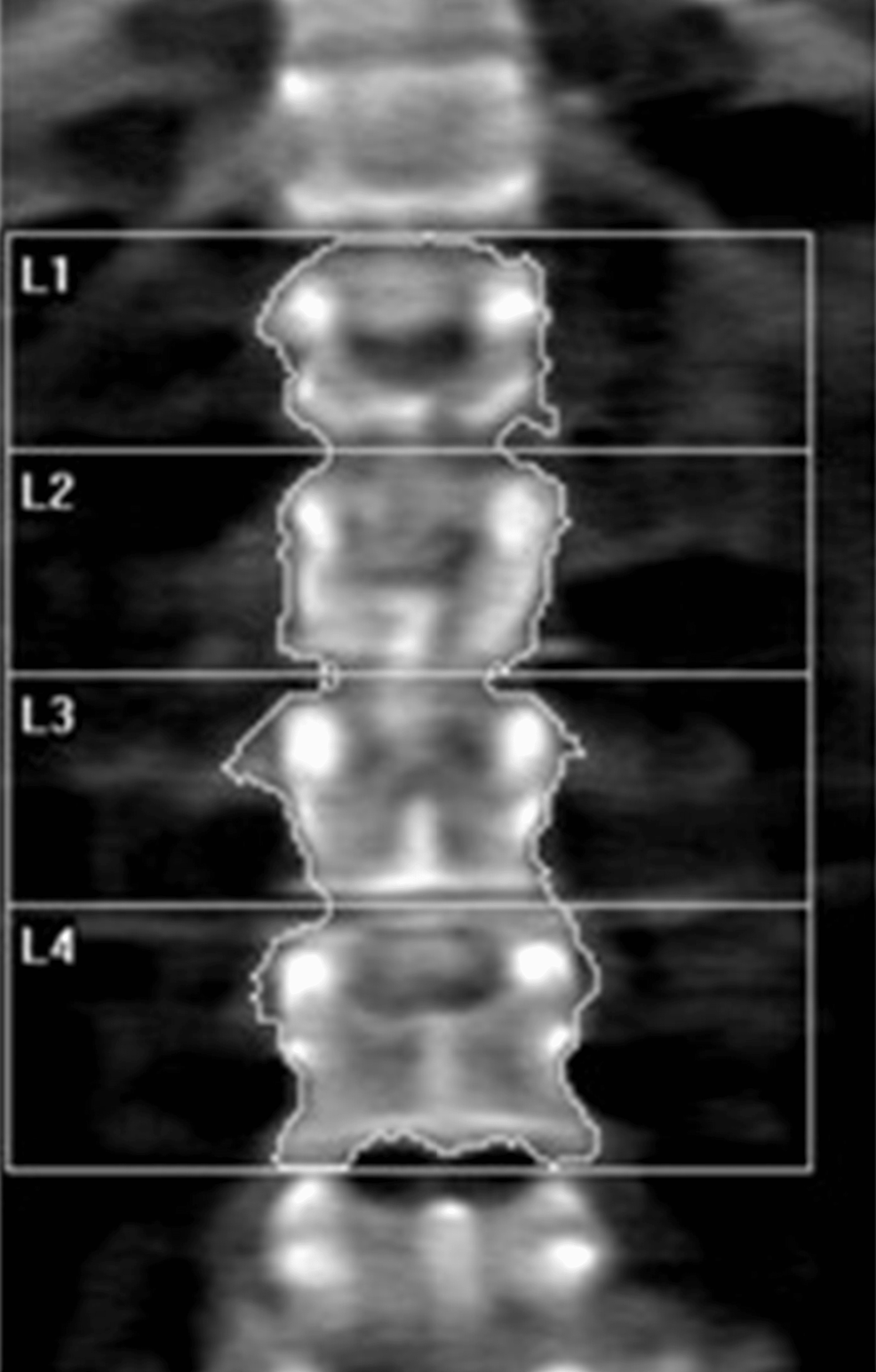 Dual-energy-X-ray-absorptiometry-(DEXA)-scan-of-the-lumbar-spine-showing-osteoporosis