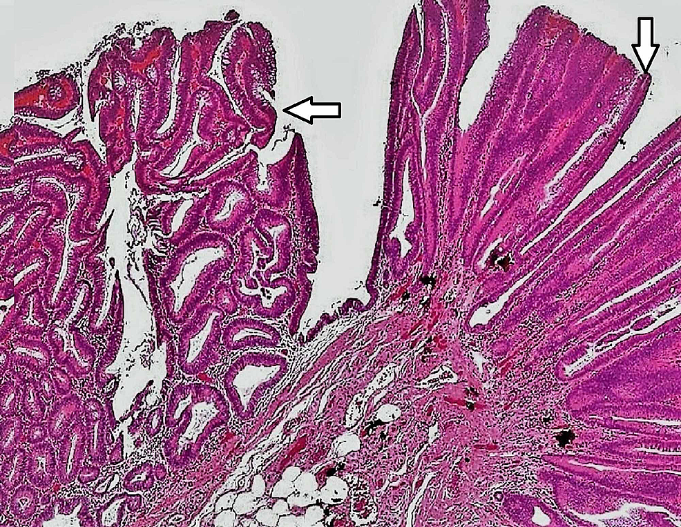 fragments of tubular adenoma and hyperplastic polyp