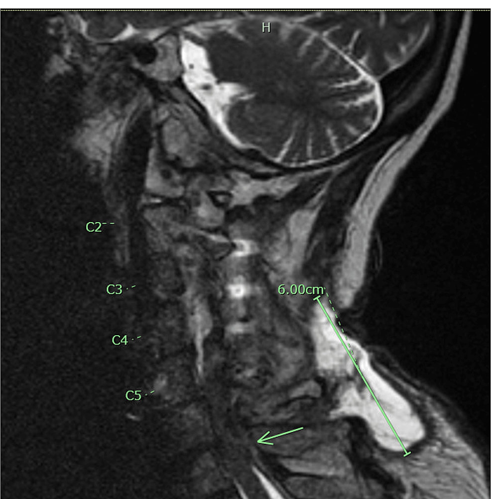 cureus-not-all-back-pain-is-muscle-strain-a-case-of-epidural-abscess