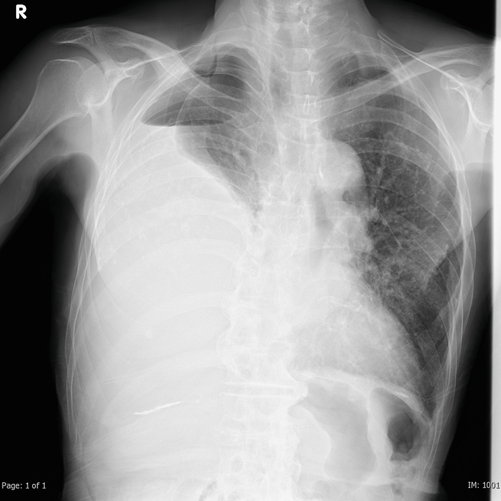 Cureus | Malignant Pleural Mesothelioma (MPM) Presenting as ...