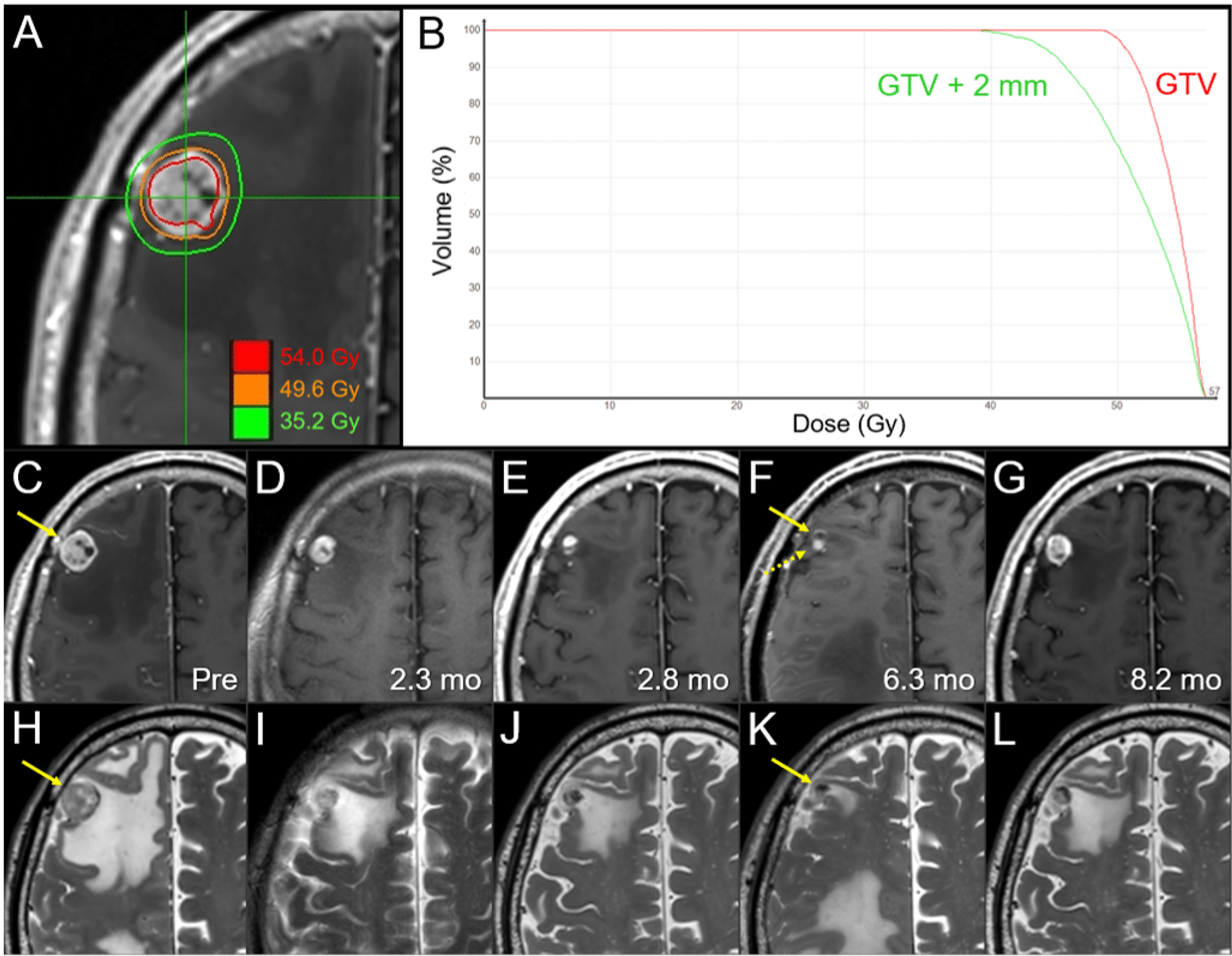 5Fraction Reradiosurgery for Progression Following 8Fraction
