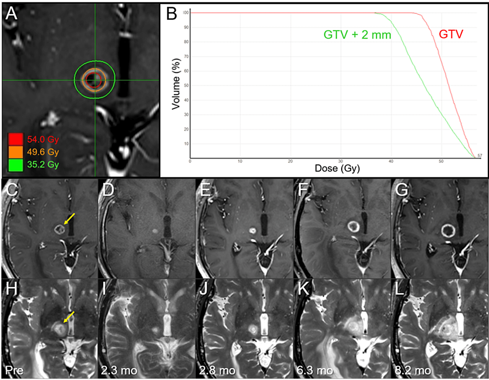 5Fraction Reradiosurgery for Progression Following 8Fraction