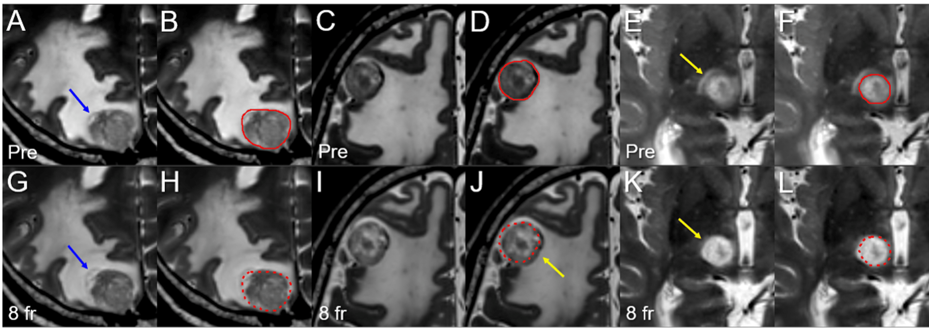 Cureus 5Fraction Reradiosurgery for Progression Following 8