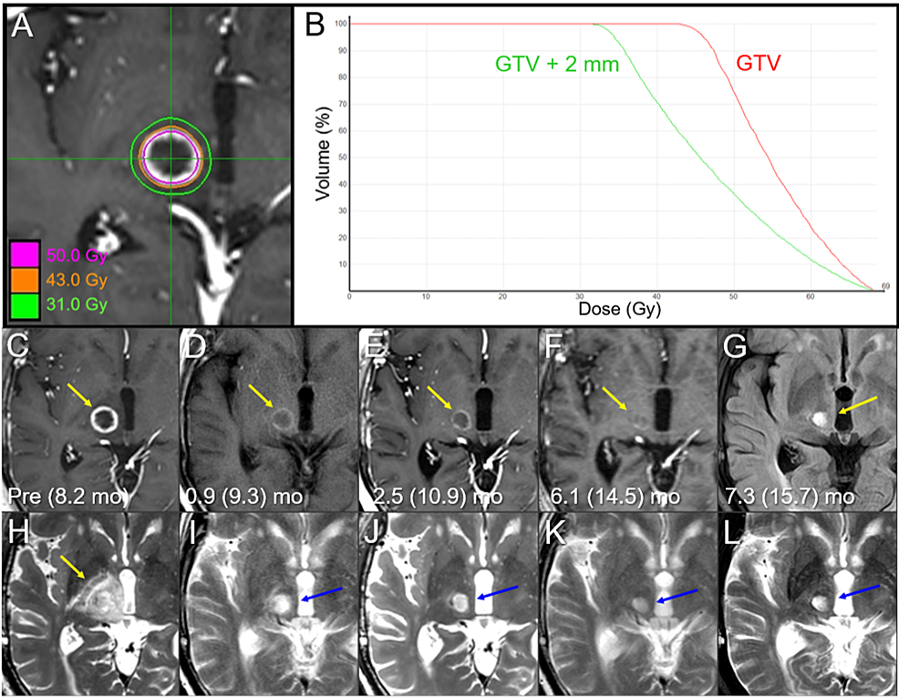 5Fraction Reradiosurgery for Progression Following 8Fraction