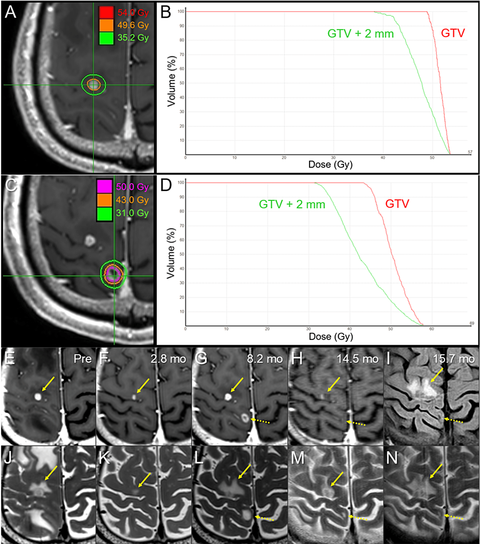 5Fraction Reradiosurgery for Progression Following 8Fraction