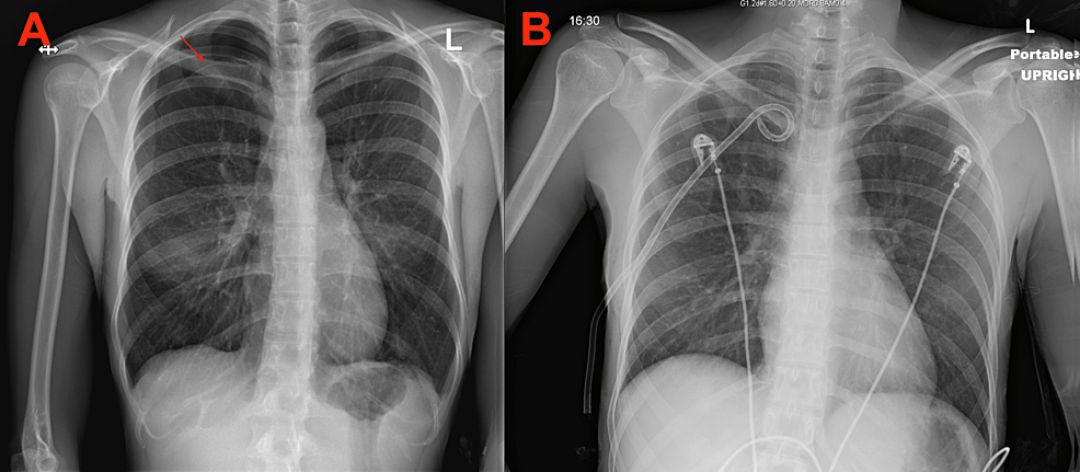 apical pneumothorax chest x ray