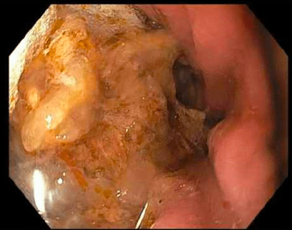 Anesthesia Considerations for a Patient on Semaglutide and Delayed Gastric  Emptying