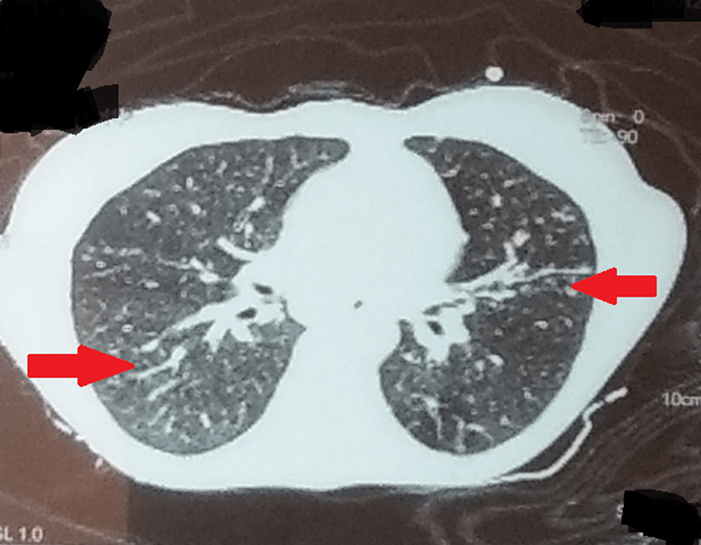 健康・医学 Tuberculosis Clinical Overview of Tuberculosis Disease | Tuberculosis (TB