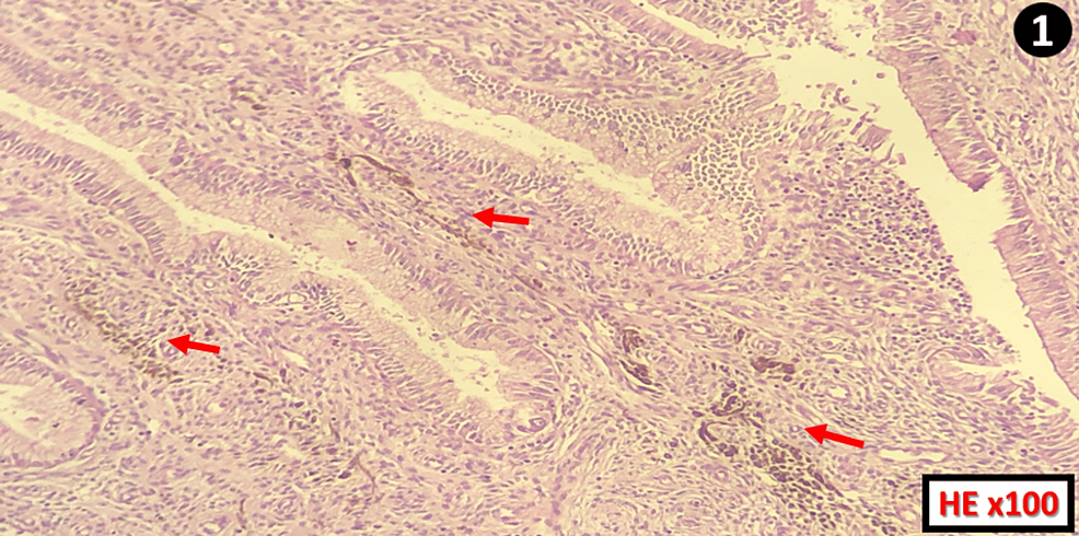 melanotic mucosa Oral macula on the lower labial vestibular on a Smoker's Melanosis in the lower