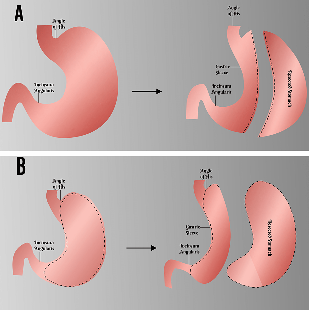 Anterior Gastric Wall Excision And Retubularization: A Novel Procedure ...