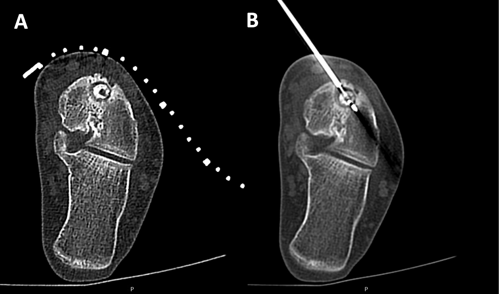 Cureus A Narrative Review of Osteoid Osteomas and an Audit on the