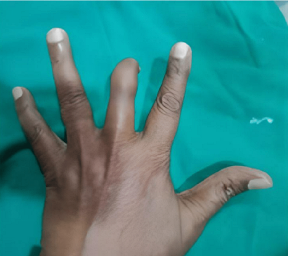 Cureus  Finger Prosthesis: An Economic and Esthetic Approach