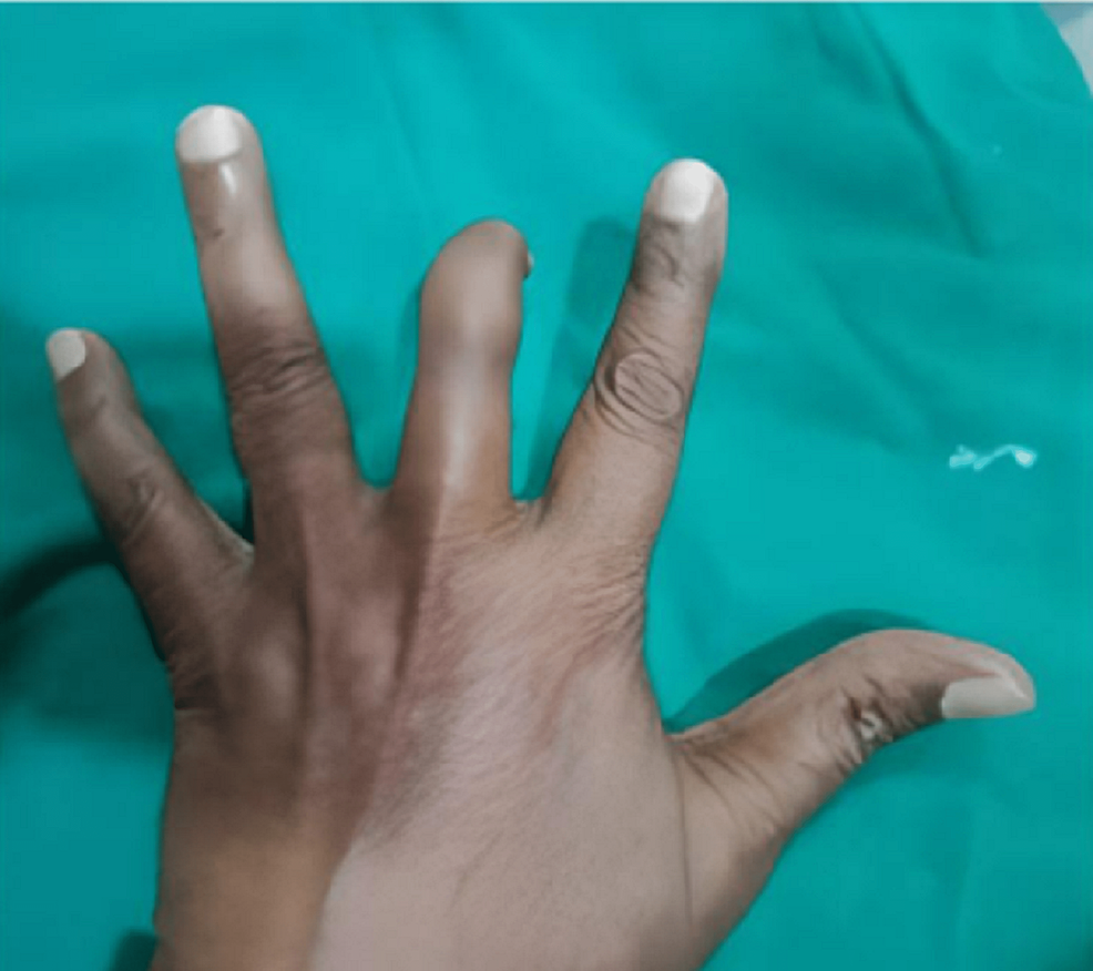 finger-prosthesis-an-economic-and-esthetic-approach-cureus