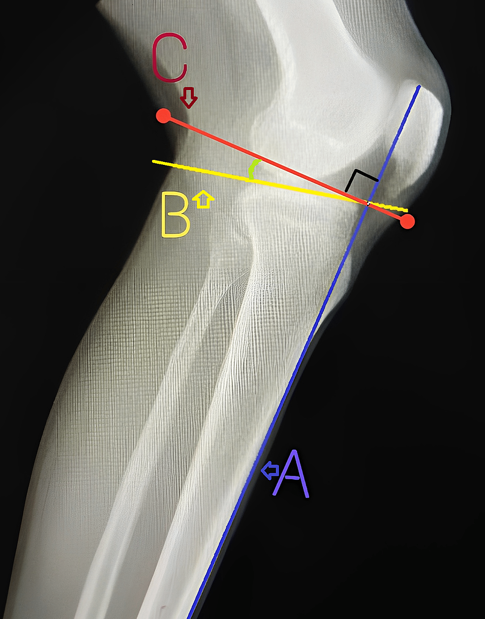 Cureus, Congenital Pseudoarthrosis of Tibia With Anterolateral Bowing  Treated With Ilizarov Ring Fixator: A Case Report