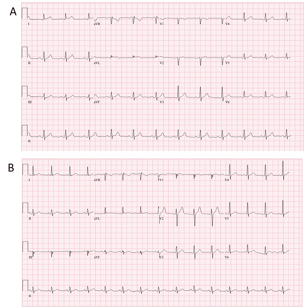 Cureus | Thymoma-Associated Myasthenia Gravis With Myocarditis