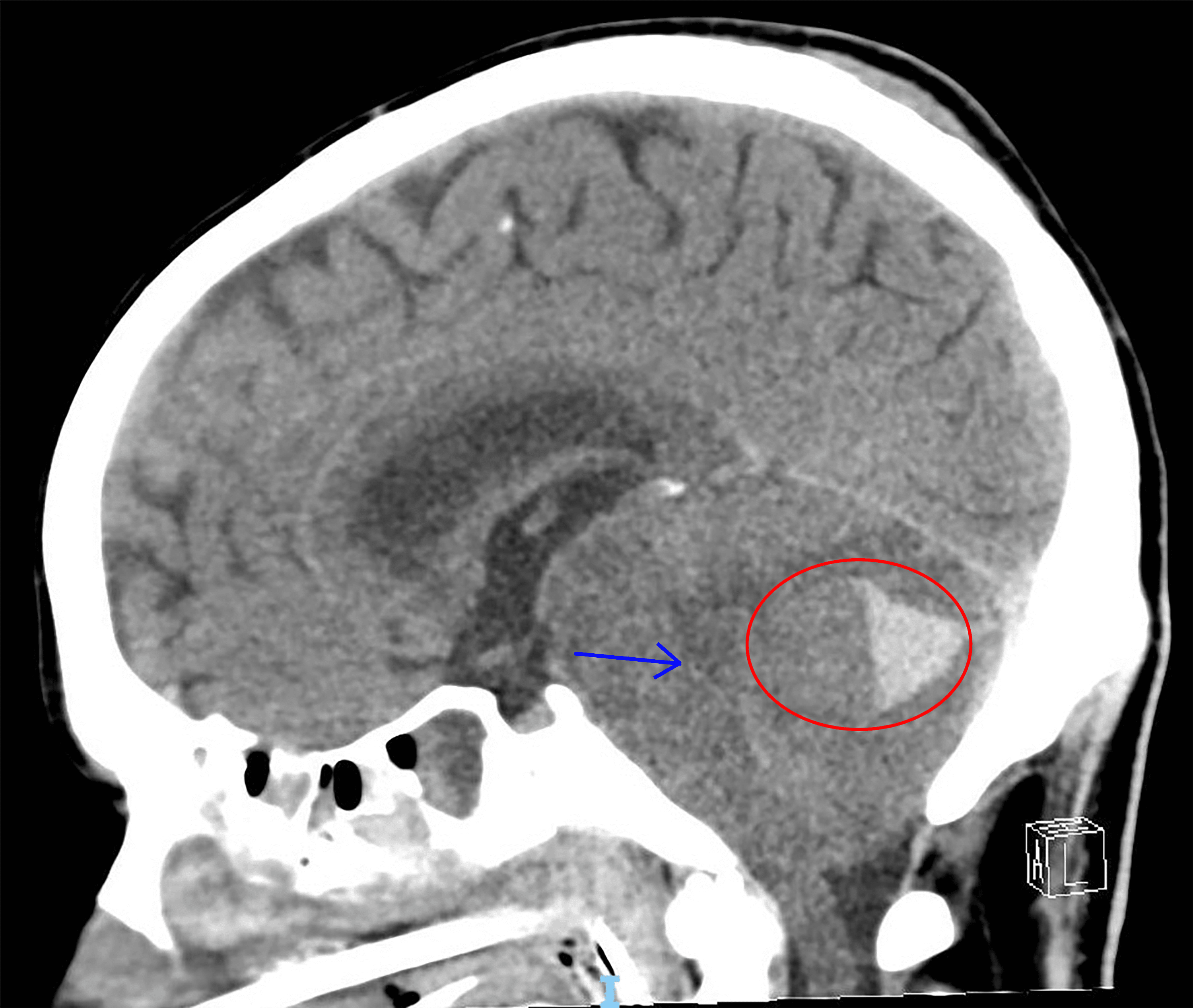 Cureus | Optic Nerve Ultrasound for Monitoring Deteriorating ...