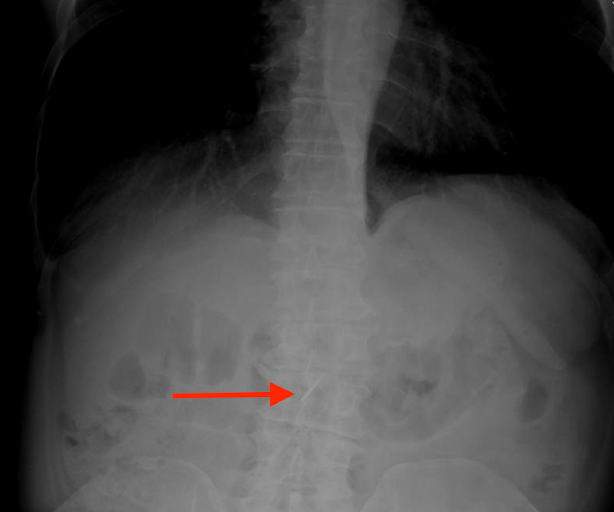 Cureus | A ‘Bit’ Of Appendicitis: A Case Of A Foreign Object In The ...