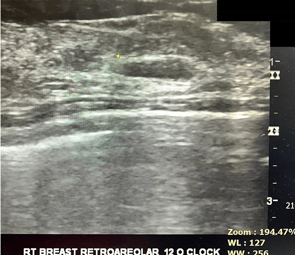 Cureus Ultrasound Guided Intraoperative Wire Localization Under