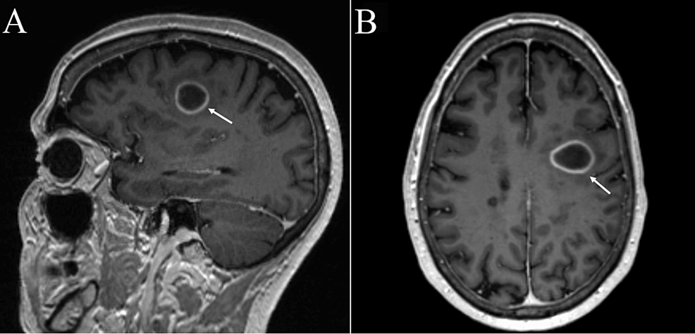 Acquired Toxoplasmosis Presenting with a Brainstem Granuloma in an  Immunocompetent Adolescent