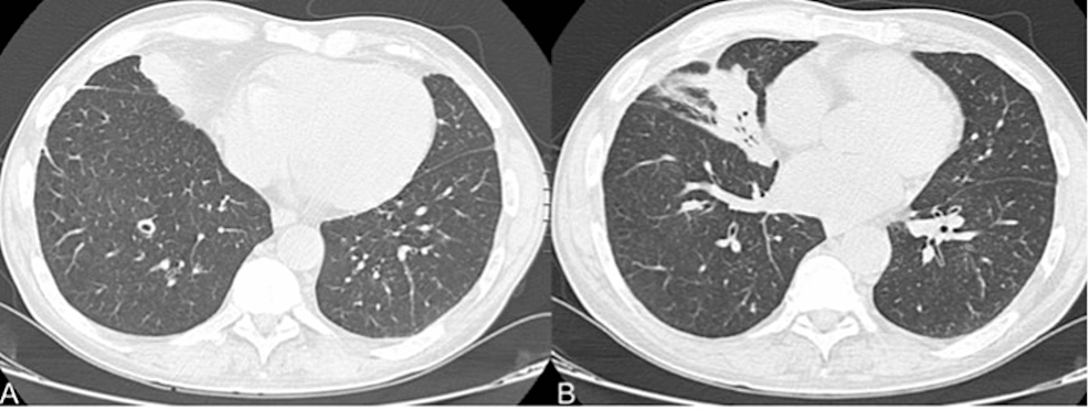 Intestinal Lesions Due To Rhodococcus Equi In A Patient With Advanced 