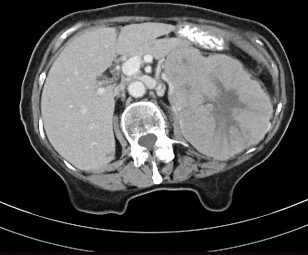 Cureus | A Giant Oncocytoma in an Elderly Female Patient: A Case Report